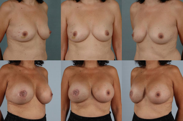 before and after breast reconstruction female patient multiple angle view case 3295