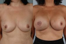 before and after breast reconstruction female patient front view case 3295
