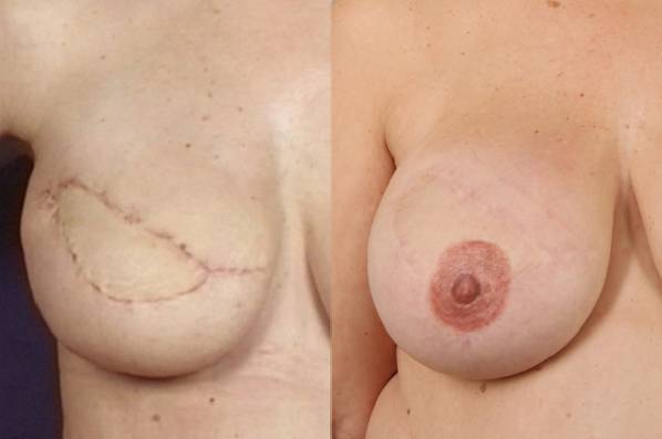 before and after breast reconstruction female patient front view case 3327
