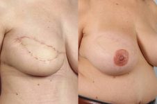 before and after breast reconstruction female patient right diagonal view case 3327