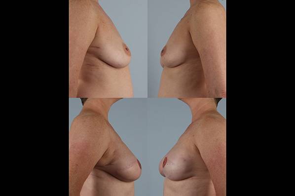 before and after breast reconstruction female patient left and right side view case 3346