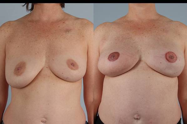before and after breast reconstruction female patient front view case 3346