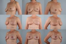 before and after breast reconstruction female patient multiple angle view case 3346