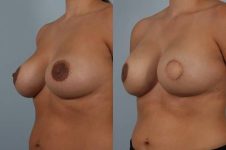 before and after breast reconstruction female patient left diagonal view case 3355