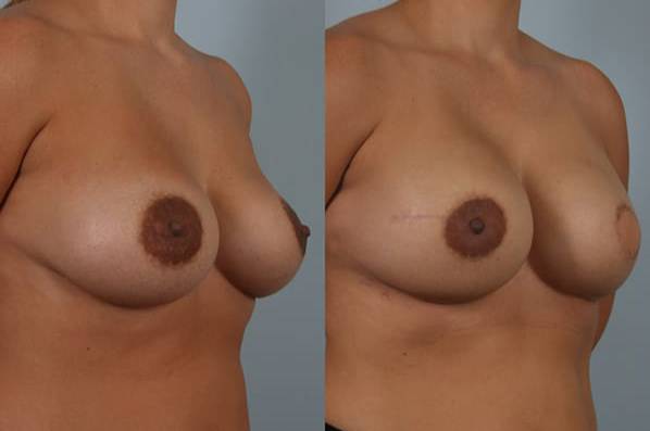 before and after breast reconstruction female patient right diagonal view case 3355