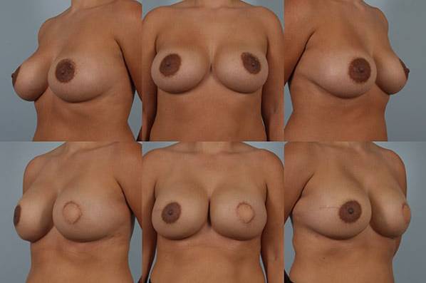 before and after breast reconstruction female patient multiple angle view case 3355