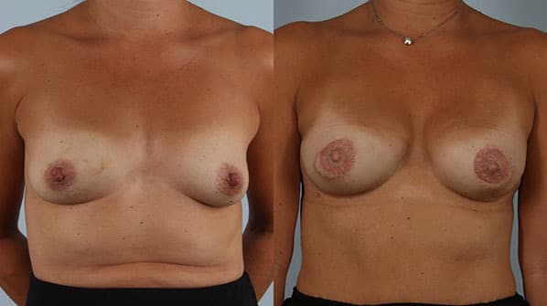 before and after breast reconstruction female patient front view case 3376