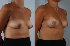 before and after breast reconstruction female patient right diagonal view case 3376