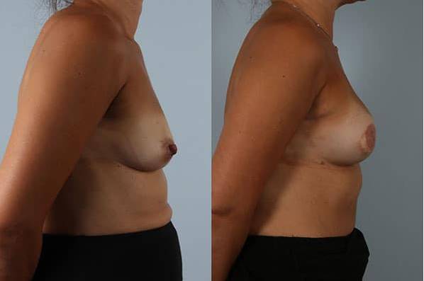 before and after breast reconstruction female patient right side view case 3376