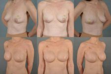 before and after breast reconstruction female patient multiple angle view case 3381