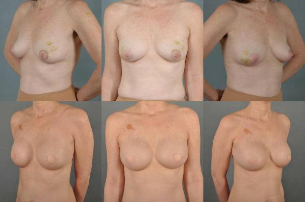 before and after breast reconstruction female patient multiple angle view case 3381