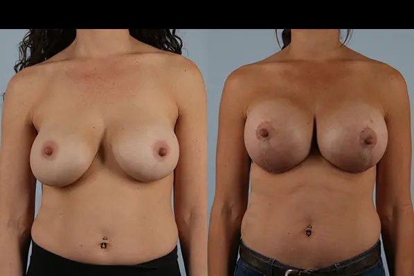 before and after breast revision female patient front view case 3244