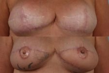 before and after breast revision female patient front view case 3271