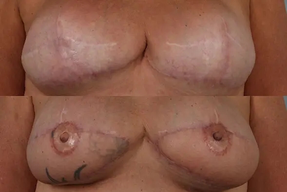 before and after breast revision female patient front view case 3271