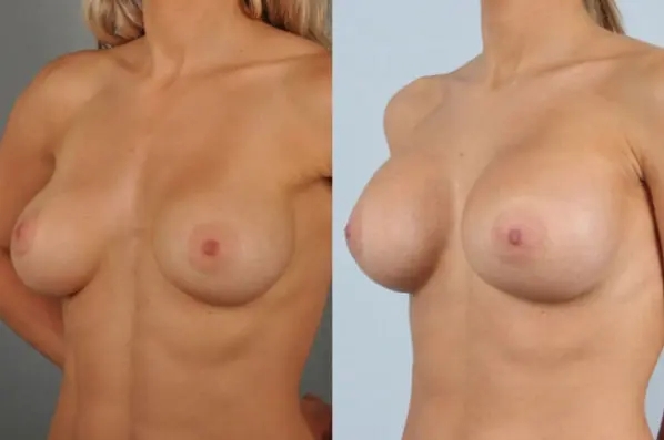 before and after breast revision female patient left diagonal view case 3276