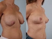 before and after breast revision female patient right diagonal view case 3294
