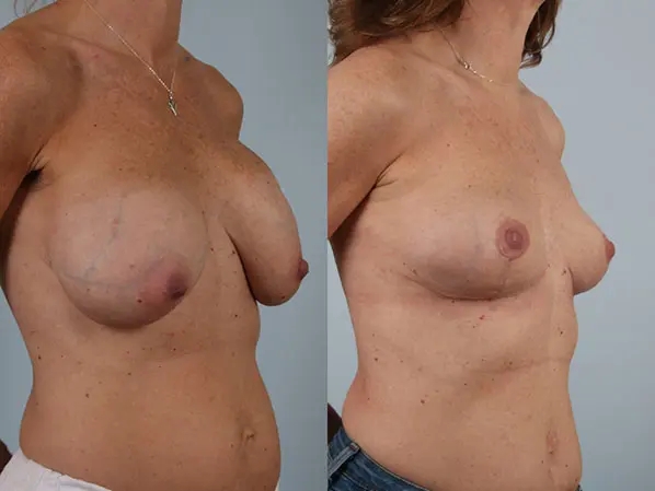before and after breast revision female patient right diagonal view case 3294