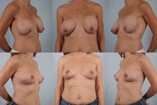 before and after breast revision female patient multiple angle view case 3294