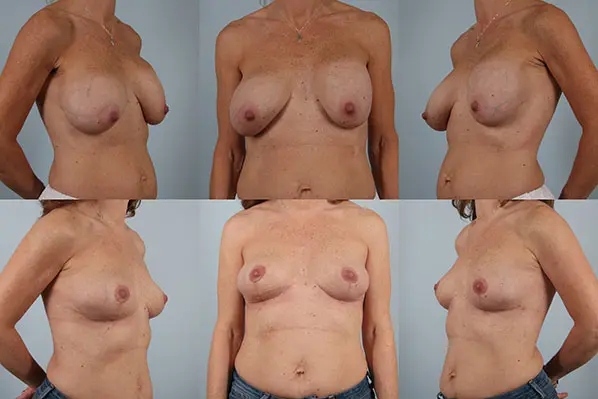 before and after breast revision female patient multiple angle view case 3294