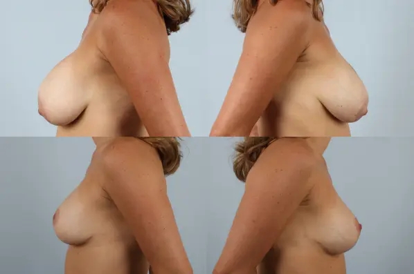 before and after breast revision female patient left and right side view case 3336