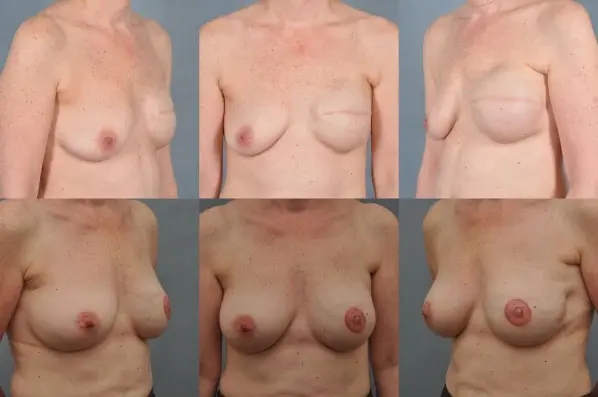 before and after breast revision female patient multiple angle view case 3391