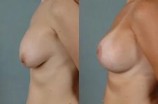 before and after breast revision female patient left side view case 3400