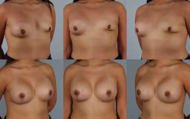 before and after breast revision female patient multiple angle view case 3461