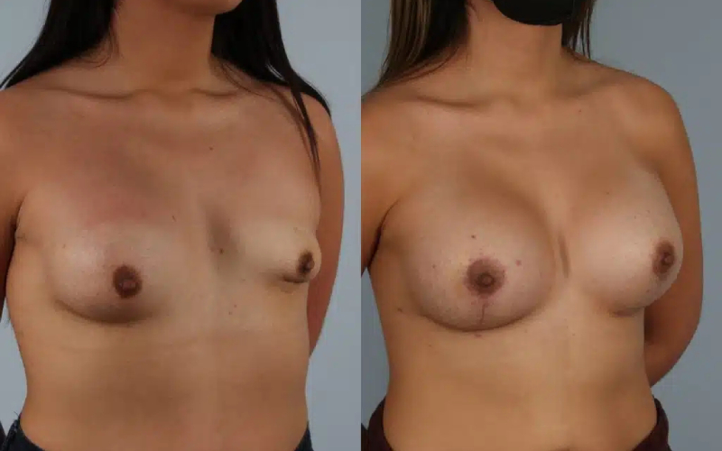 before and after breast revision female patient right diagonal view case 3461