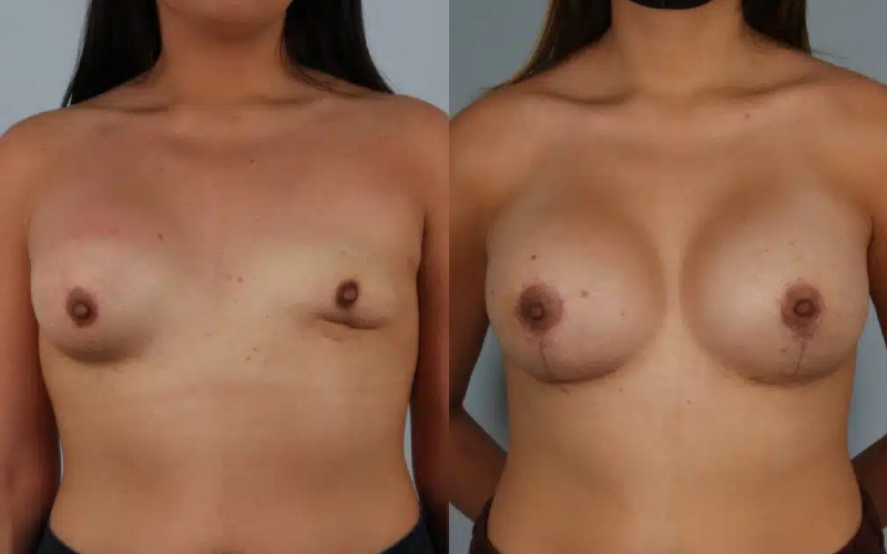 before and after breast revision female patient front view case 3461