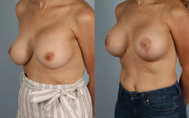 before and after breast revision female patient left diagonal view case 3457