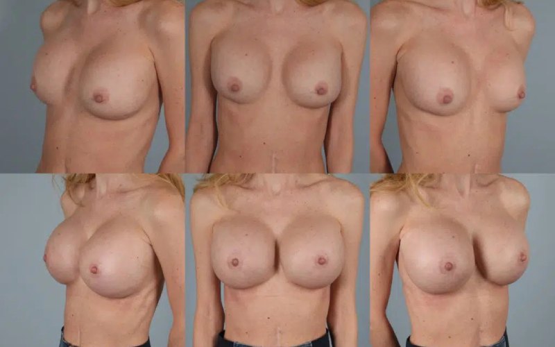 before and after breast revision female patient multiple angle view case 3447