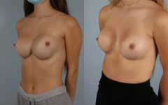 before and after breast revision female patient left diagonal view case 3443