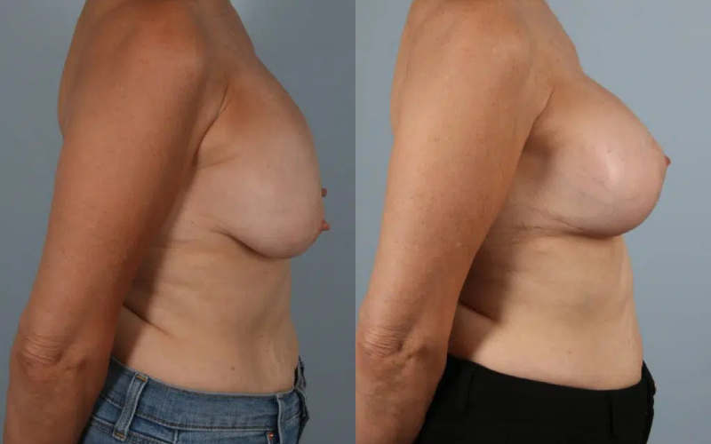 before and after breast revision female patient right side view case 3414