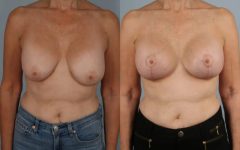 before and after breast revision female patient front view case 3414