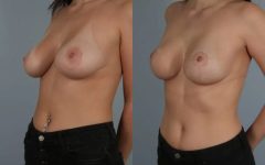before and after breast revision female patient left diagonal view case 3077