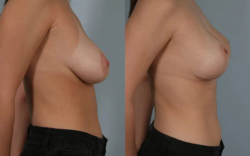 before and after breast revision female patient right side view case 3077
