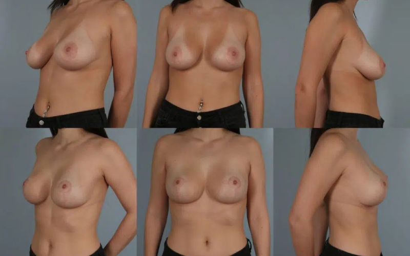 before and after breast revision female patient multiple angle view case 3077