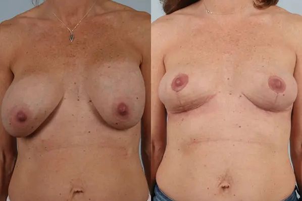 before and after breast revision front view case 3294