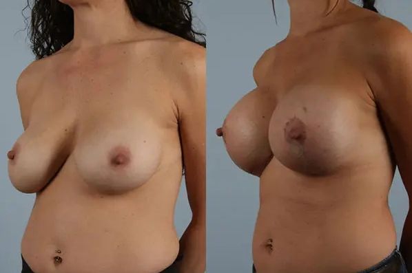 before and after breast revision left angled view case 3244