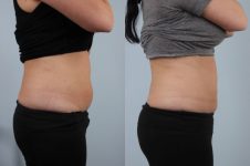 before and after coolsculpting right side view female patient case 697