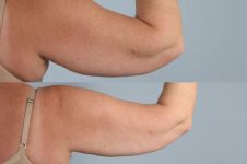 before and after coolsculpting right arm back view female patient case 703
