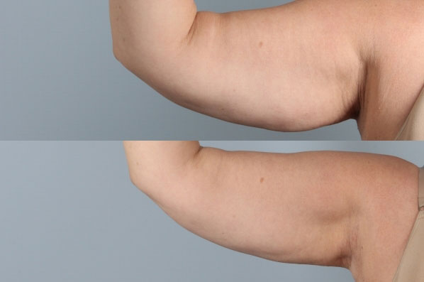 before and after coolsculpting right arm front view female patient case 703