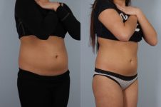 before and after coolsculpting right view female patient case 706
