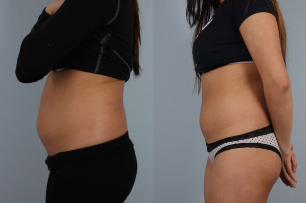 before and after coolsculpting left side view female patient case 706