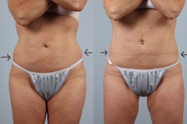 before and after coolsculpting front view female patient case 710