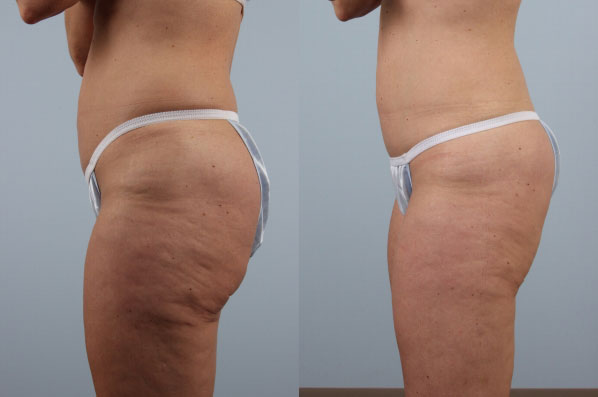 before and after coolsculpting left side view female patient case 710