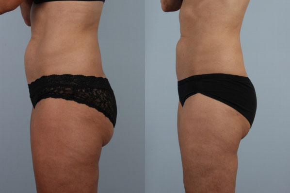 before and after coolsculpting left side view female patient case 715
