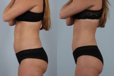 before and after coolsculpting left side view female patient case 718