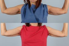 before and after coolsculpting front view female patient case 727