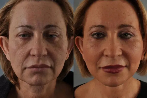before and after facial fat grafting front view female patient case 1777